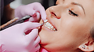 What to Expect After Getting Veneers