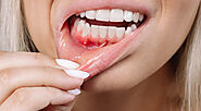 How to Recognize the Early Signs of Gum Disease