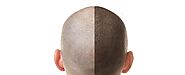 the Best Hair Loss Treatment in Delhi at The Face Centre