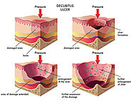 Decubitus Ulcer Wound Care, Prevention and Documentation