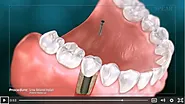 Dental implants Summerlin