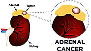 Top-Notch Adrenal Cancer Treatment in Ahmedabad by Dr. Rohan Patel - Ananta Urology & Robotics Clinic