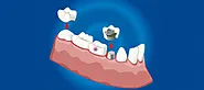 Best Dental Crowns in Chennai | Dental crowns services in Chennai | Peakdentistryai.com