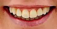 Best smile makeover treatments in Chennai | Smile Design Dentistry in Chennai | Peakdentistryai.com