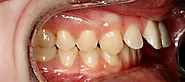 Best Teeth Straightening Services in Chennai | Teeth Straightening Orthodontic Treatment in Chennai | Peakdentistryai...