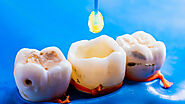 Signs You Might Need a Dental Filling
