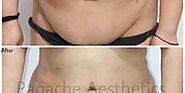 Liposuction vs Tummy Tuck