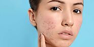 Advanced Acne Subcisions: Treating Deep Acne Scars Near Me | Laser Therapy - Cost, Before and After Results. The Best...