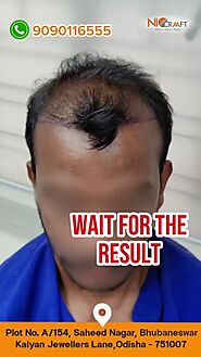 Niocraaft experts performs painless hair transplants. Book your consultation now and get ready to flaunt your new loo...