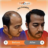 Top Hair Transplant Clinic in Bhubaneswar | Niocraaft