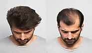 Website at https://aestheticclinicriyadh.com/hair-transplant-in-riyadh/