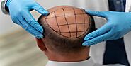 Hair Transplant In Riyadh - Hurray Flat 30% Off