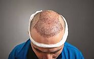 Hair Transplant In Riyadh - Hair Transplant Clinic Near Me