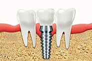 Can Full Dental Implants Be Done in One Visit?