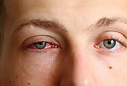 What is Pink Eye? Causes, Symptoms, and Prevention.