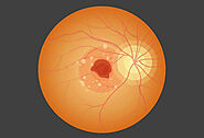 Wet Macular Degeneration Treatment Breakthrough