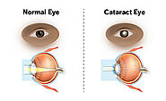 Cataract Eye Surgery in Delhi - Dr Anisha Gupta