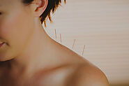 Acupuncture Treatment San Diego | Beauty Kliniek