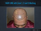 Hair Transplant Clinic, Hair Transplant Surgery, Hair Fall Solution Provider, Pakistan