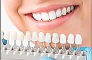 Porcelain Veneers