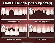 Dental Bridges