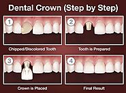 Dental Crowns