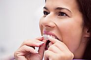 Teeth Aligners & Straightening | Invisalign Clinic in Calgary - Galaxy Dental