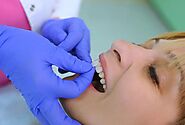 What To Expect When Getting Dental Veneers