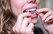 The Real Cost of Invisalign: A Guide for Patients in Cameron Park, CA