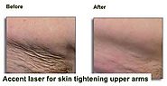Accentuate Your Appearance With Skin Tightening Procedures