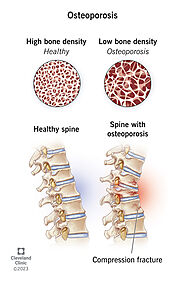 Osteoporosis: Symptoms, Causes and Treatment