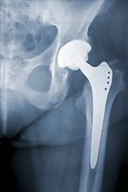 Affordable Hip Replacement Surgery Cost in India: Starting at $4500