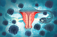 Ovarian Cancer Treatment Cost in India Starting at Just $4000 | HOSPIDIO