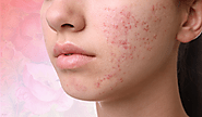 Can AviClear® Help with Acne Scars?