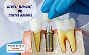 Dental Implants Vs Dental Bridge: Finding What’s Best For You?