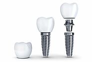 All About The Evolution Of Dental Implants | Blake Dental