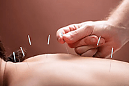 Acupuncture in Edmonton