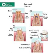 Everything You Need to Know About Root Canal Therapy