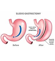 Specialized Gastric Sleeve Revision in St. Louis