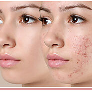 Acne Treatment Gerrards Cross