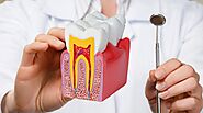 Root Canal Treatment in Dubai | Elite Body Home Polyclinic