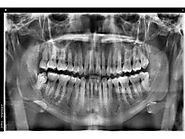 Find minimally invasive Veneers in Tijuana with ultra-thin custom-made shells Tijuana