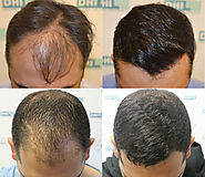 Affordable Hair Transplant Cost in Bangalore: DHI