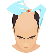 Restore Hair Growth with PRP in Calicut – DHI