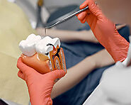 Root Canal Treatments