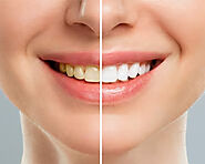 Teeth Whitening