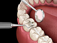 Dental Sealants Market Set to Reach USD 1.6 Billion by 2033 at a 4.5% of CAGR , Driven by Rising Demand for Cosmetic ...