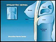 Epigastric hernia