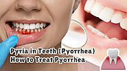 Pyria in Teeth (Pyorrhea): How to Cure Pyria from teeth? - SellersBay India