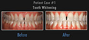Teeth Whitening in Orange County